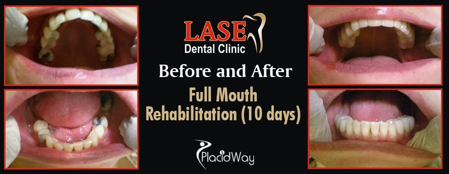 Before and After Full Mouth Rehabilitation in Mumbai, India